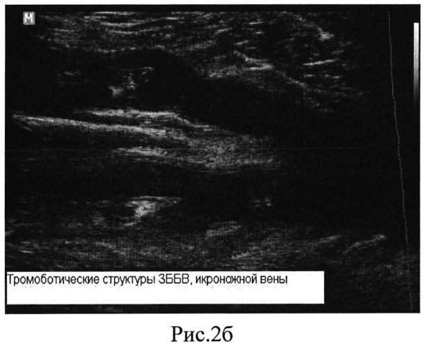 Способ ультразвуковой диагностики начальных этапов формирования тромбозов глубоких вен голени в раннем послеоперационном периоде (патент 2547072)