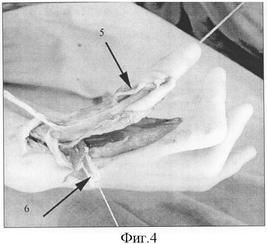 Способ восстановления функции кисти при сочетании врожденной гипоплазии и аплазии первого пальца кисти с лучевой косорукостью (патент 2300333)