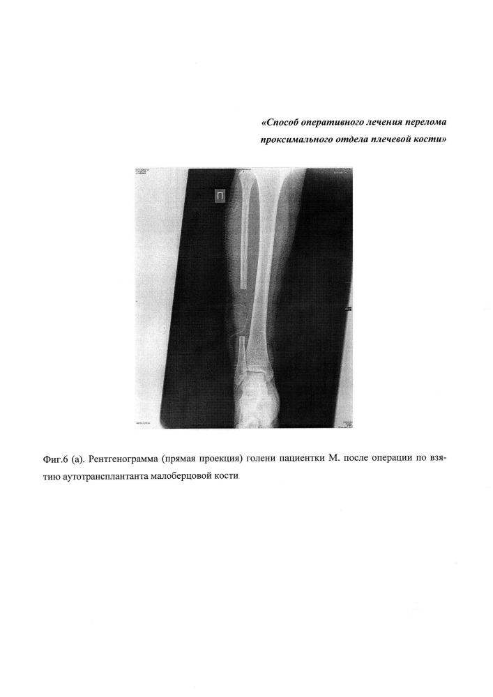 Способ хирургического лечения перелома проксимального отдела плечевой кости (патент 2652573)