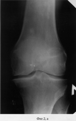 Способ лечения деформирующего артроза коленного сустава (патент 2286736)