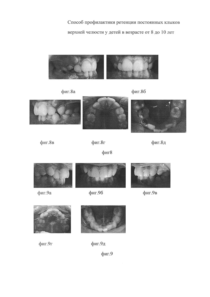 Способ профилактики ретенции постоянных клыков верхней челюсти у детей в возрасте от 8 до 10 лет (патент 2633479)