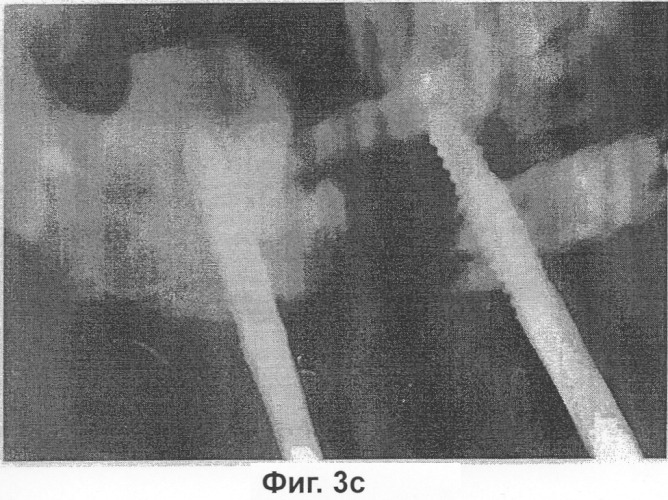 Заливочная композиция для стимуляции образования кости и сращения кости, содержащая сульфат кальция и вязкие биополимеры (патент 2296588)
