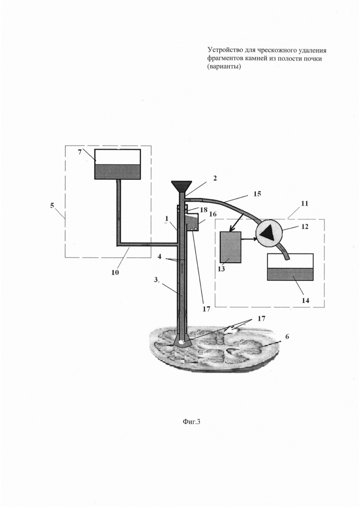 Устройство для чрескожного удаления фрагментов камней из полости почки (варианты) (патент 2637820)