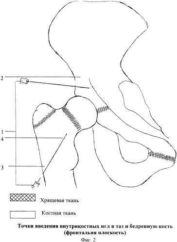 Способ внутрикостного введения лекарственных препаратов при болезни легга-кальве-пертеса (блкп) (патент 2367478)