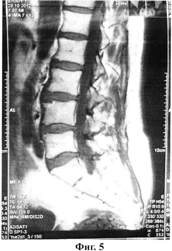 Способ лечения грыж поясничных межпозвонковых дисков (патент 2577239)