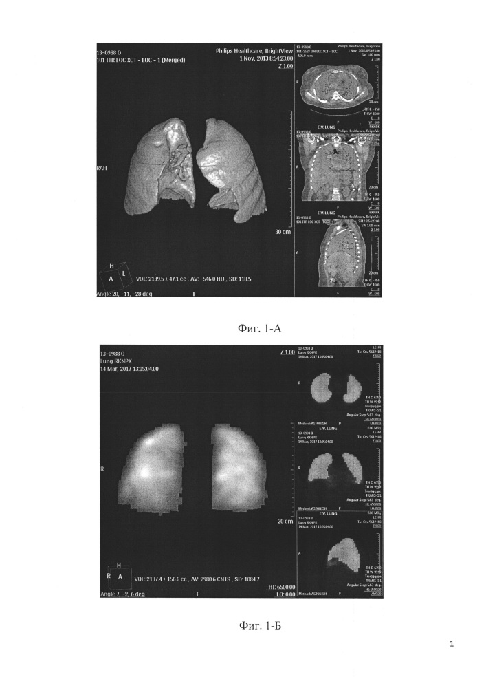 Способ количественной оценки объема нарушений перфузии легких (патент 2653994)