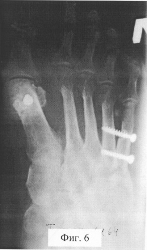 Способ фиксации пятой плюсневой кости при ее остеотомии (патент 2323696)