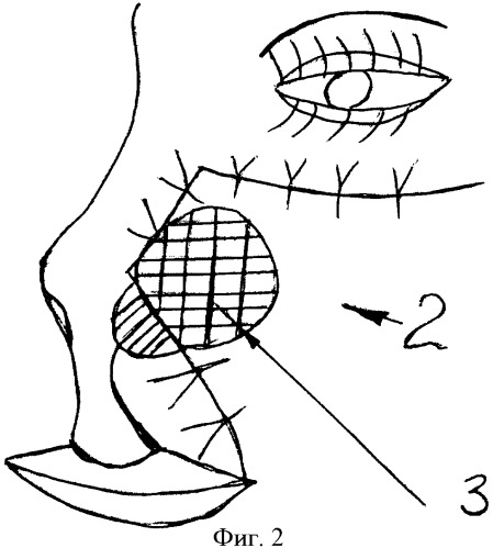 Способ хирургического лечения сквозного дефекта крыла носа (патент 2394511)