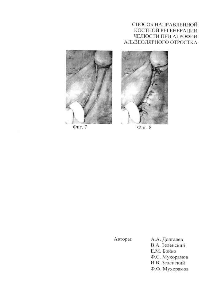 Способ направленной костной регенерации челюсти при атрофии альвеолярного отростка (патент 2648861)