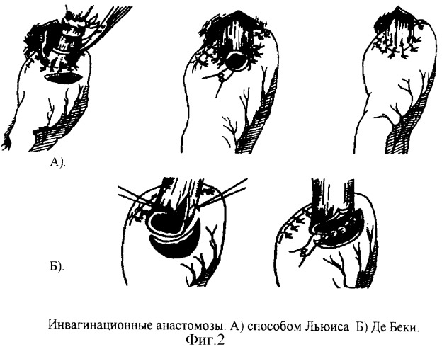 Новый способ формирования эзофагогастроанастомоза в условиях недостатка пластического материала путем модификации задней губы (патент 2248185)