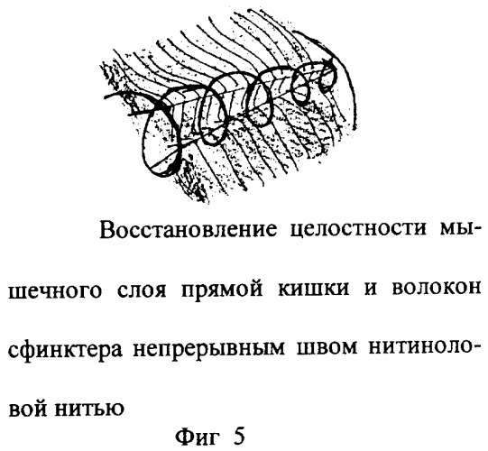 Способ хирургической коррекции сложных параректальных свищей (патент 2290881)