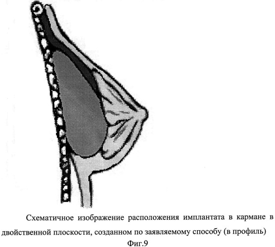 Способ формирования кармана для имплантата в двойственной плоскости при аугментационной маммопластике (патент 2498777)