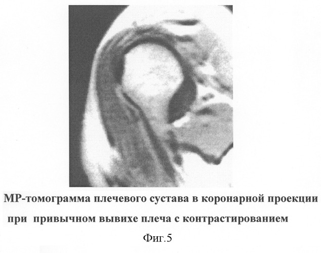 Способ диагностики нестабильности плечевого сустава (патент 2277852)