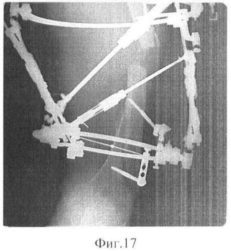 Способ остеосинтеза аппаратом орто-сув для лечения повреждений дистальной трети бедренной кости (патент 2448663)