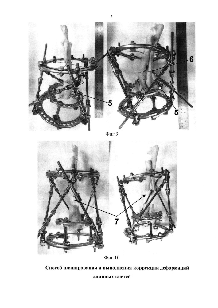 Способ планирования и выполнения коррекции деформаций длинных костей (патент 2641840)