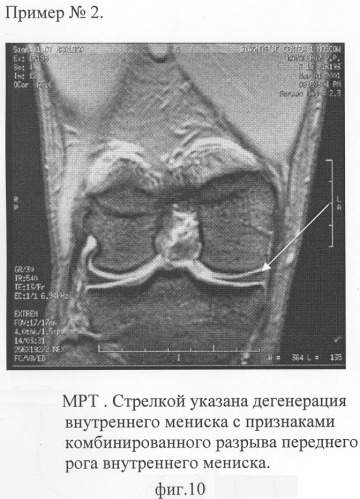 Способ комплексной ультразвуковой диагностики повреждения внутреннего мениска коленного сустава в области тела и переднего рога (патент 2305493)