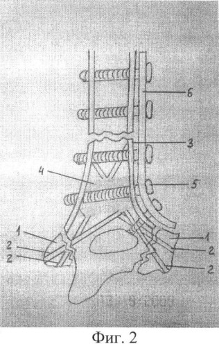 Способ лечения оскольчатых переломов трубчатых костей (патент 2424777)