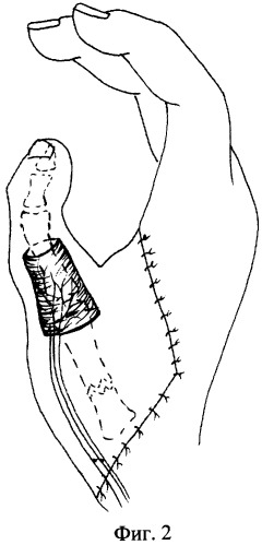 Способ двухэтапной пересадки пальца стопы на кисть (патент 2345726)