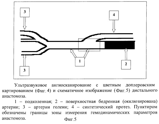 Способ диагностики функциональной полноценности сосудистого анастомоза после реконструктивных хирургических вмешательств (патент 2266711)