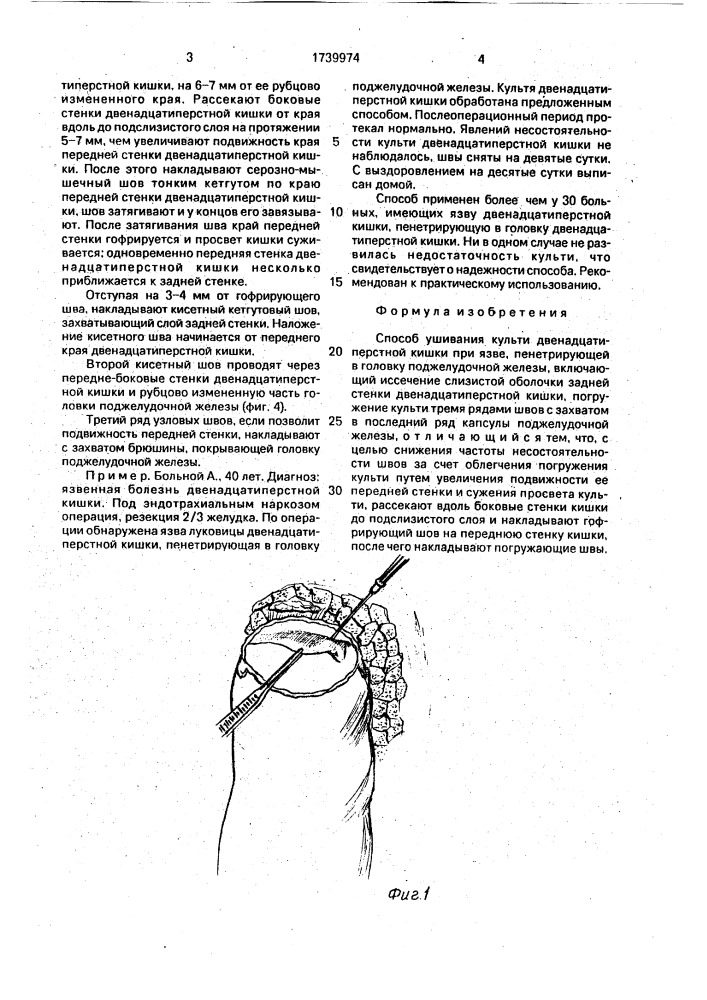 Способ ушивания культи двенадцатиперстной кишки при язве, пенетрирующей в головку поджелудочной железы (патент 1739974)