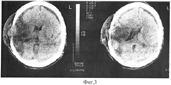 Способ лечения черепно-мозговой травмы (патент 2366466)