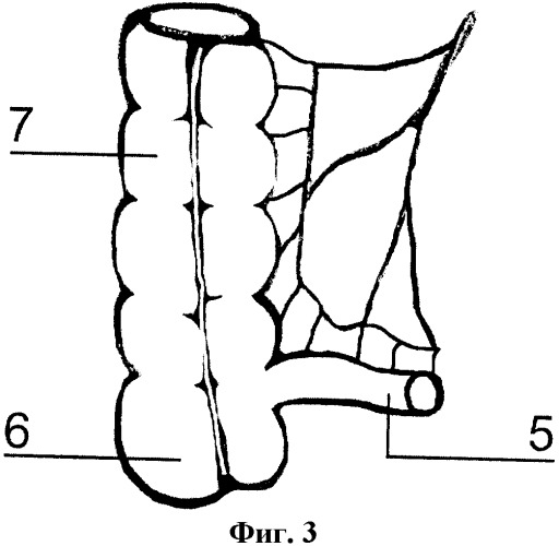 Способ формирования артифициального мочевого пузыря (патент 2363391)