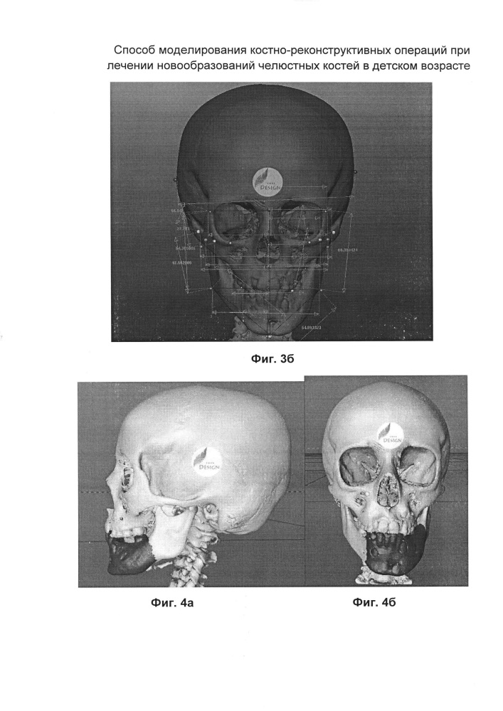 Способ моделирования костно-реконструктивных операций при лечении новообразований челюстных костей в детском возрасте (патент 2607651)
