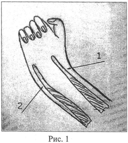 Способ восстановления сухожилий разгибателей кисти у больных с артрогрипозом (патент 2414184)