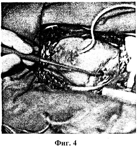 Электродное устройство для картирования эпикардиальной поверхности сердца (патент 2314020)