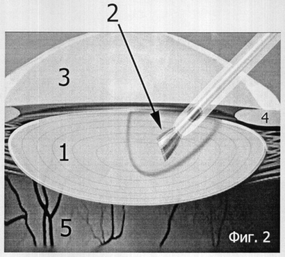 Способ мономануального формирования борозд в ядре хрусталика во время операции ультразвуковой факоэмульсификации методом &quot;вертикального грувинга&quot; (патент 2308249)