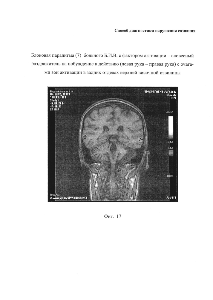 Способ диагностики нарушения сознания (патент 2596049)