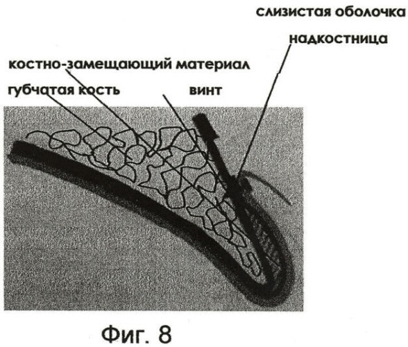 Способ туннельной остеопластики альвеолярного гребня во фронтальном отделе верхней челюсти (патент 2445939)