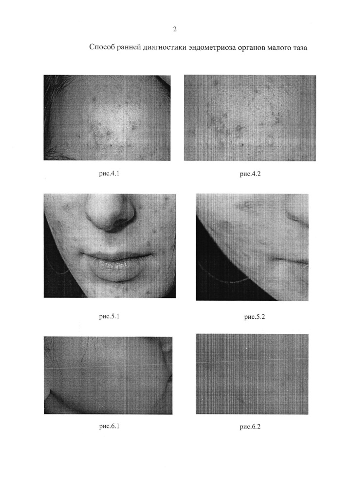 Способ ранней диагностики эндометриоза органов малого таза (патент 2616995)