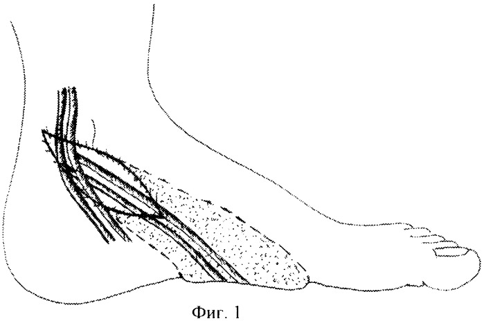 Способ реконструкции мягкотканых дефектов опорной поверхности стопы (патент 2343863)
