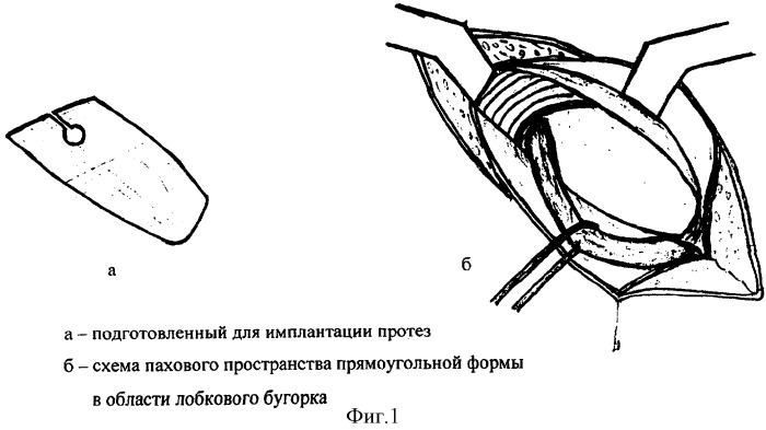 Способ герниопластики при паховых грыжах (патент 2338467)