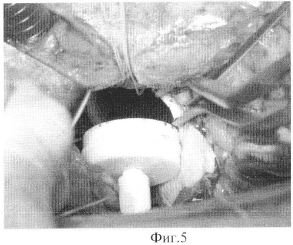 Способ имплантации механического протеза клапана сердца (патент 2454204)