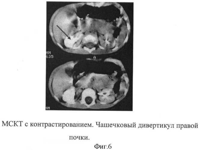 Способ дифференциальной диагностики чашечковых дивертикулов и солитарных кист почек у детей (патент 2411910)