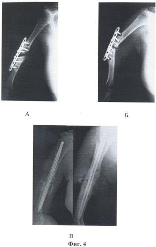 Способ лечения ложных суставов длинных костей (патент 2438608)