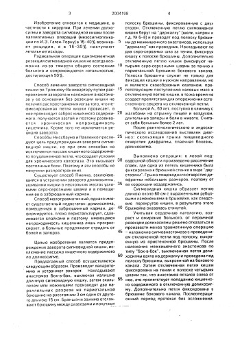 Способ лечения долихосигмы и заворота сигмовидной кишки (патент 2004198)