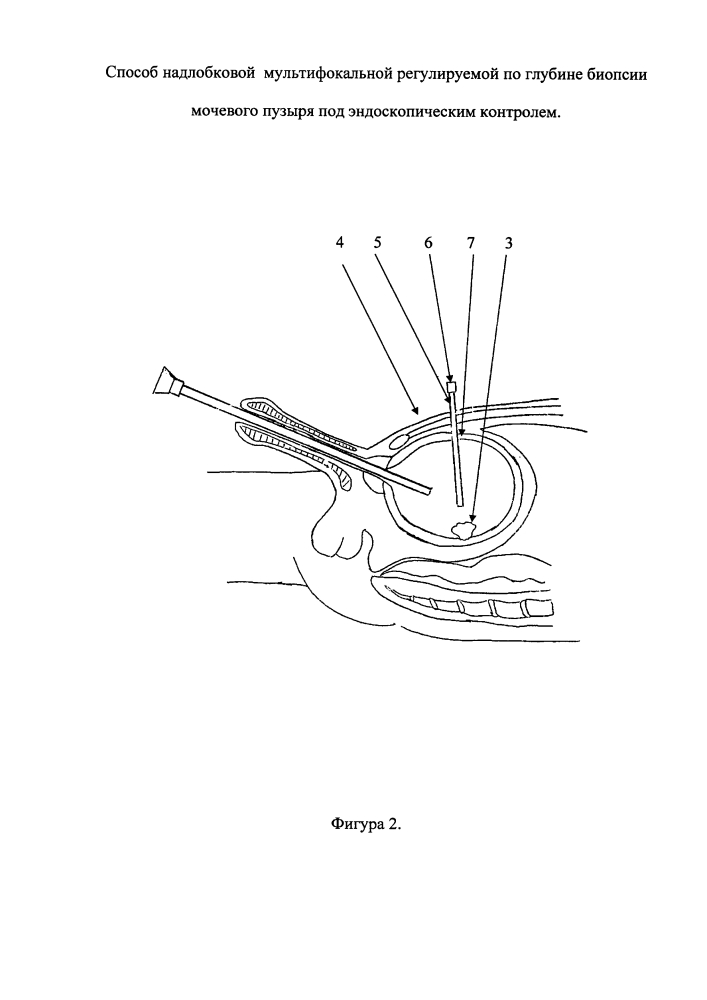 Способ надлобковой мультифокальной регулируемой по глубине биопсии мочевого пузыря под эндоскопическим контролем (патент 2641838)