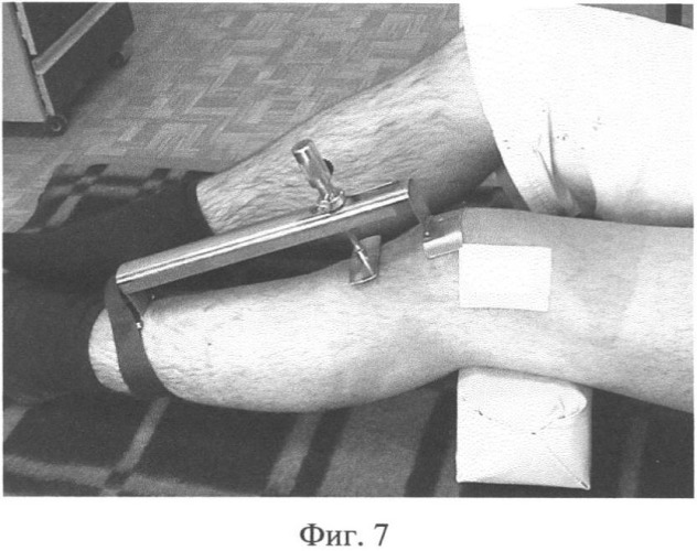 Устройство для исследования передне-задней нестабильности коленного сустава (патент 2336816)