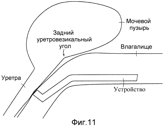 Коррекция стрессового недержания мочи (патент 2548825)