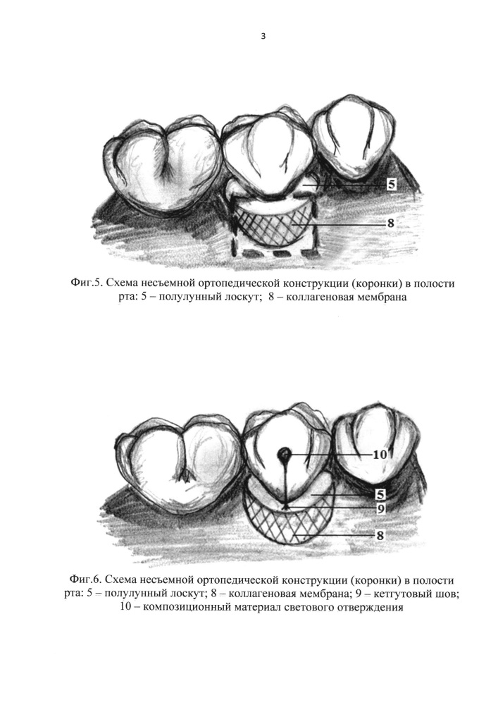 Способ лечения рецессии десны (патент 2649138)