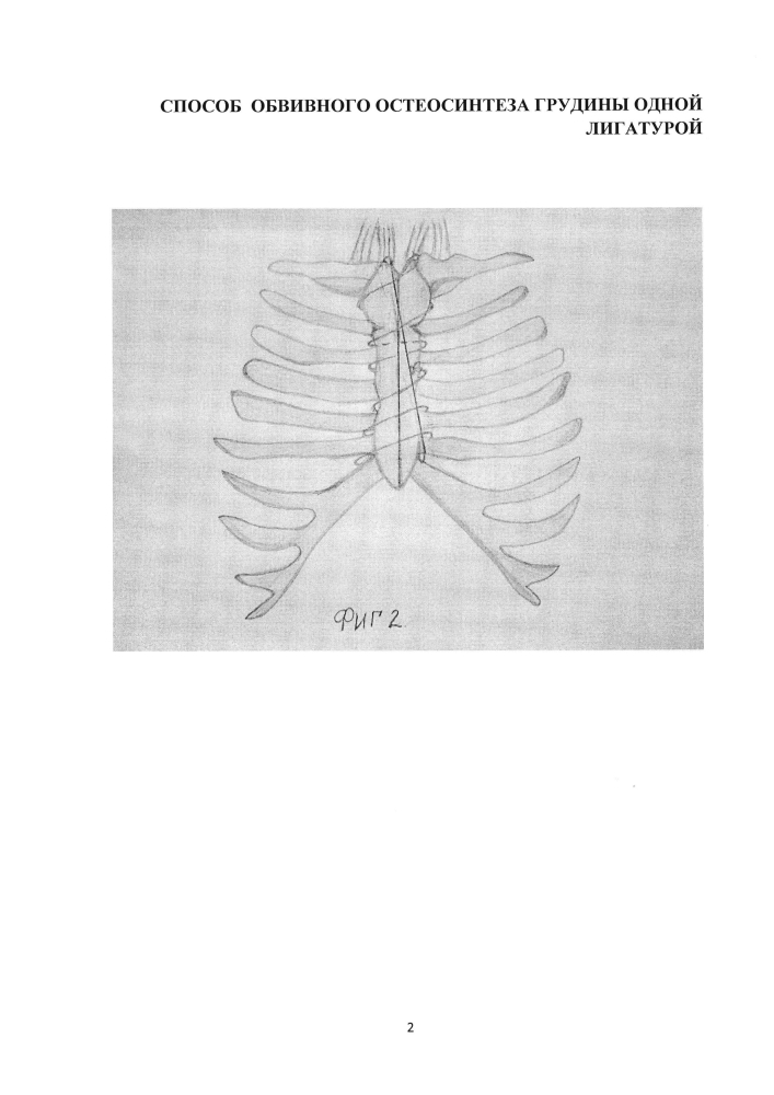 Способ обвивного остеосинтеза грудины одной лигатурой (патент 2598123)