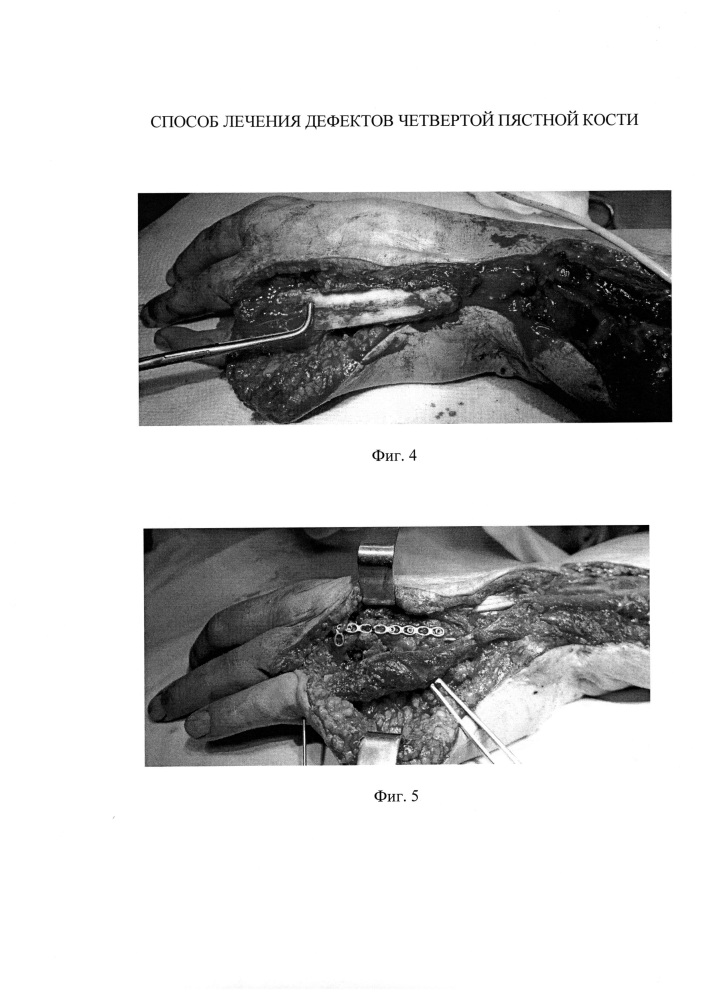 Способ лечения дефектов четвертой пястной кости (патент 2610534)