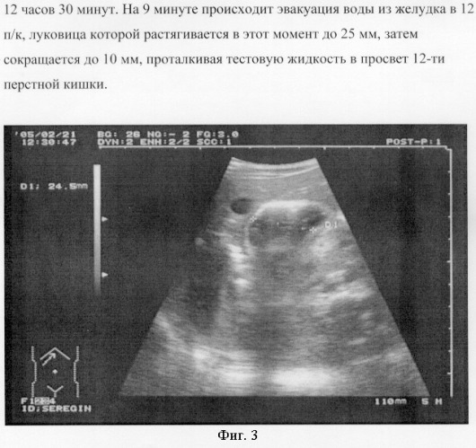 Способ определения сроков начала энтерального питания у детей в отделении реанимации (патент 2294147)