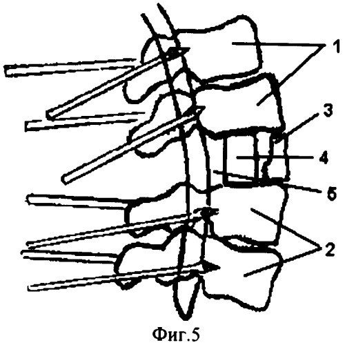 Способ хирургического лечения последствий переломов позвоночника (патент 2279859)