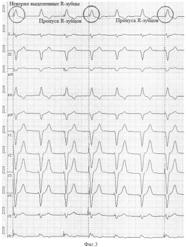 Способ выделения начала реполяризации желудочков сердца (патент 2522392)