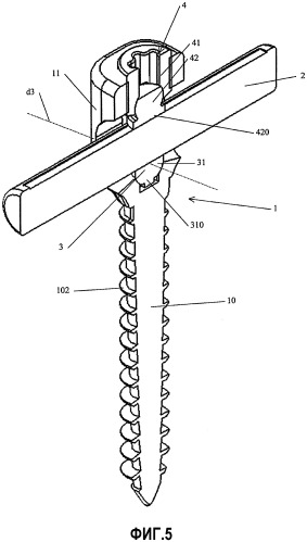 Имплантат с многоосной головкой для закрепления в кости (патент 2302839)