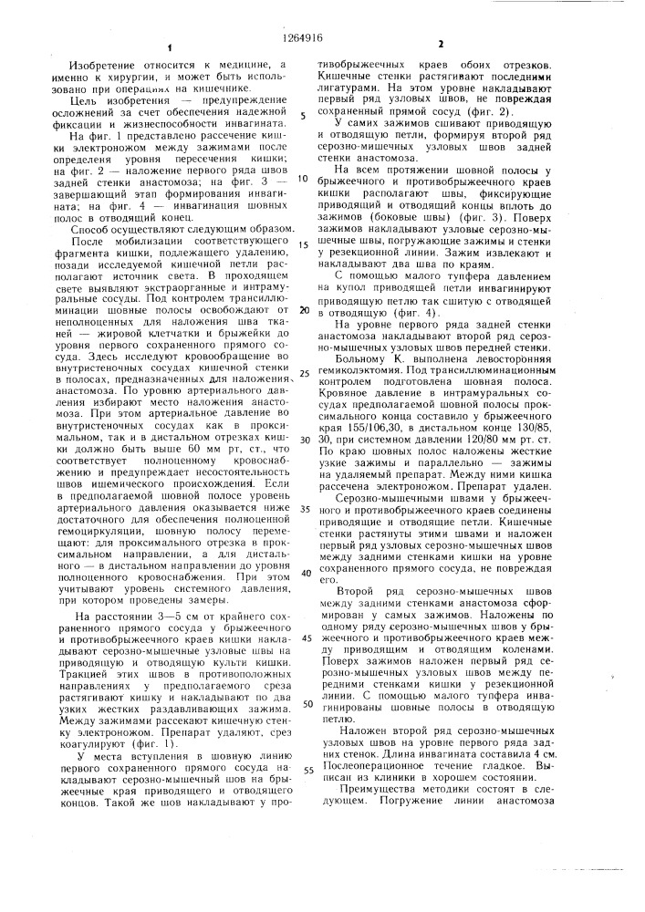 Способ формирования концевого межкишечного анастомоза (патент 1264916)